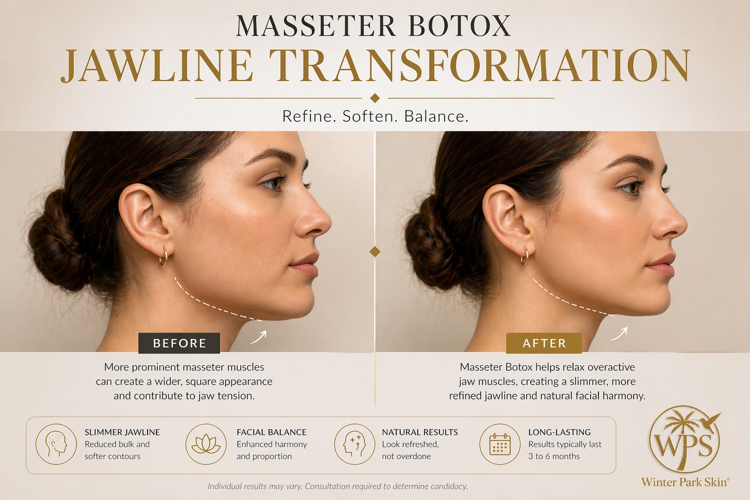Masseter Botox Jawline Transformation Orlando | Winter Park Skin Masseter Botox jawline transformation in Orlando showing lower face slimming and jaw contour refinement